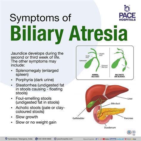 symptoms of bile leak|Leaking Bile Duct Symptoms, Causes, Diagnosis, and Treatment